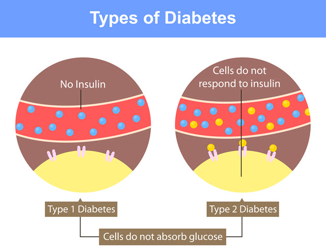 Diabetes Types.