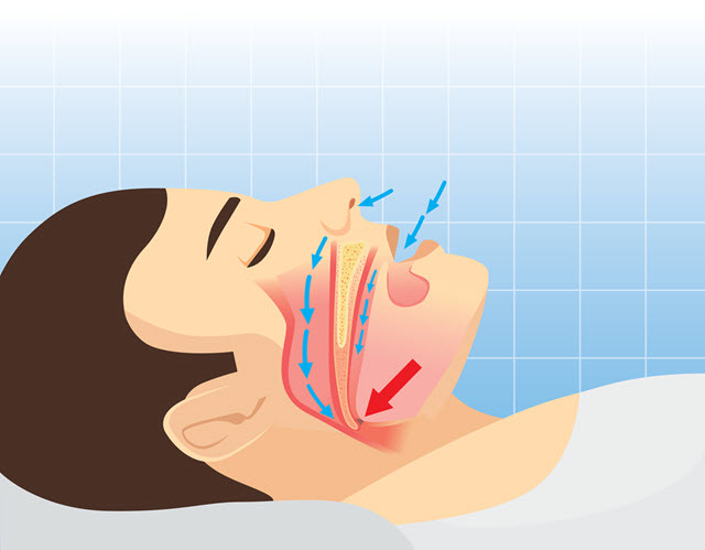 Human Airway Anatomy Snoring.