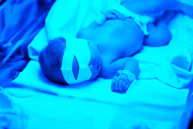 Infant Phototherapy Treatment.