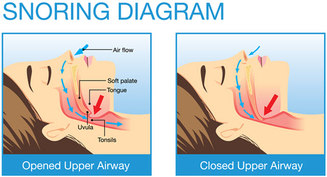 Snoring Diagram.